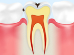 C1 エナメル質の虫歯