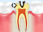 C2 象牙質の虫歯