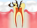C3 神経の虫歯