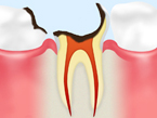 C4 歯の根の虫歯