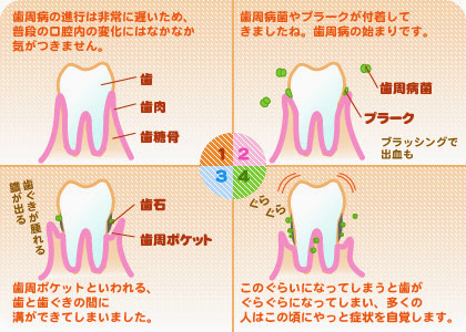 歯ぐきが腫れる 血が出る 歯周病 むらかみ歯科 上石神井駅スグの痛くない歯医者さん